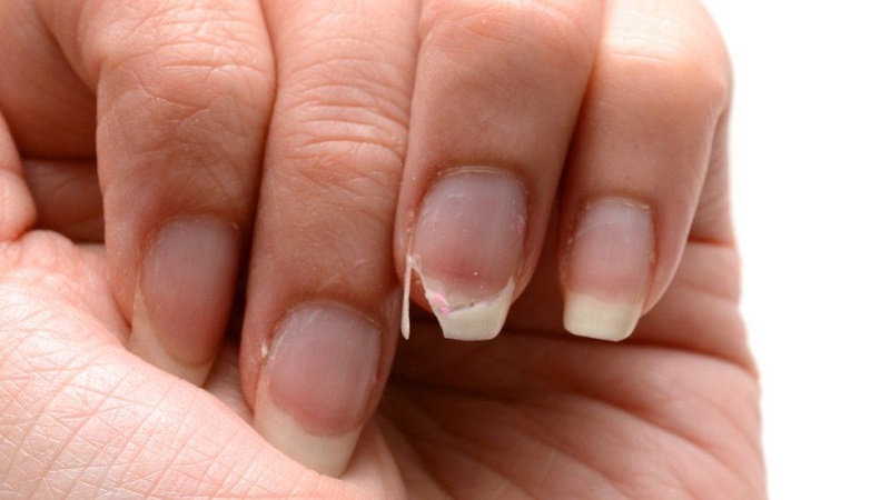 Why do your nails break? 5 mistakes you can easily avoid - Dress24h
